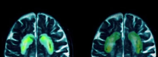 This is your brain on sugar vs cocaine…